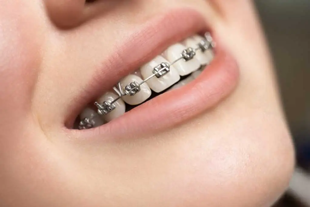 Regular Braces