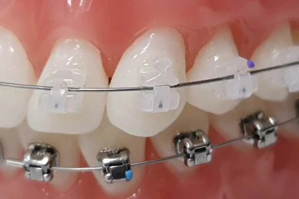 Self-Ligating Braces